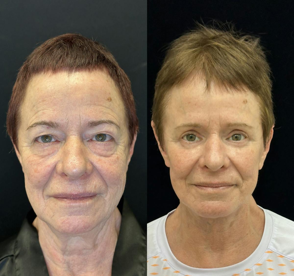 Lower Blepharoplasty Before & After Gallery - Patient 346693 - Image 4