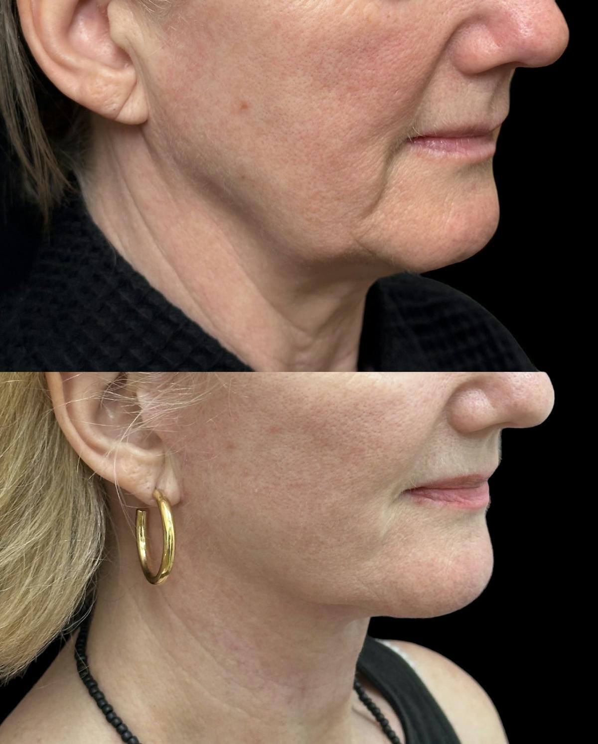 Deep Plane Facelift Before & After Gallery - Patient 949281 - Image 2