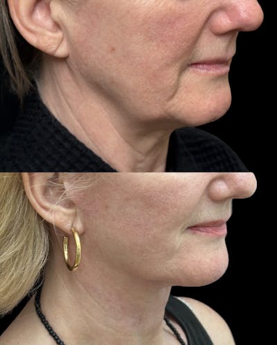 Deep Plane Facelift Before & After Gallery - Patient 949281 - Image 2