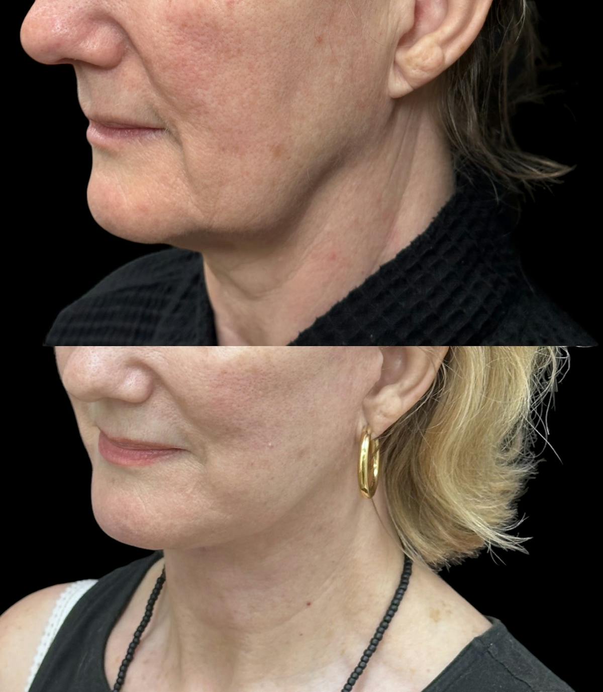 Deep Plane Facelift Before & After Gallery - Patient 949281 - Image 1