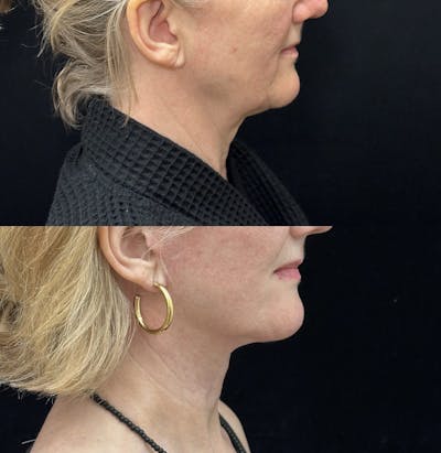 Deep Plane Facelift Before & After Gallery - Patient 949281 - Image 4