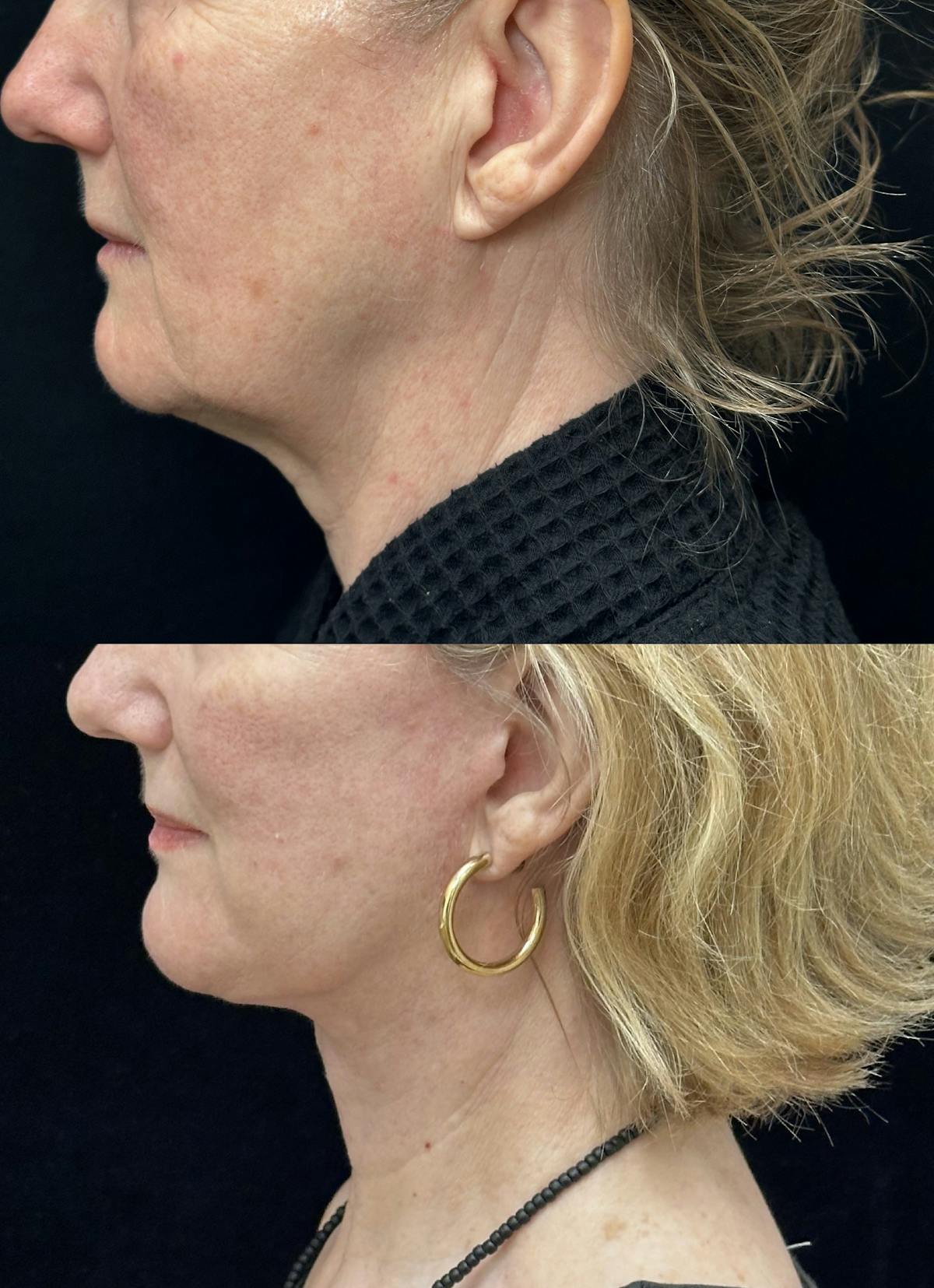 Deep Plane Facelift Before & After Gallery - Patient 949281 - Image 3