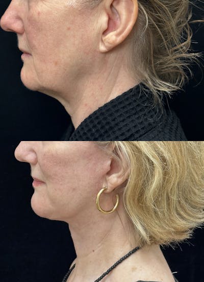 Deep Plane Facelift Before & After Gallery - Patient 949281 - Image 3