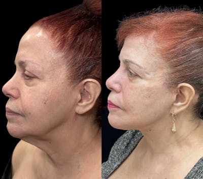 Deep Plane Facelift Before & After Gallery - Patient 109873 - Image 1
