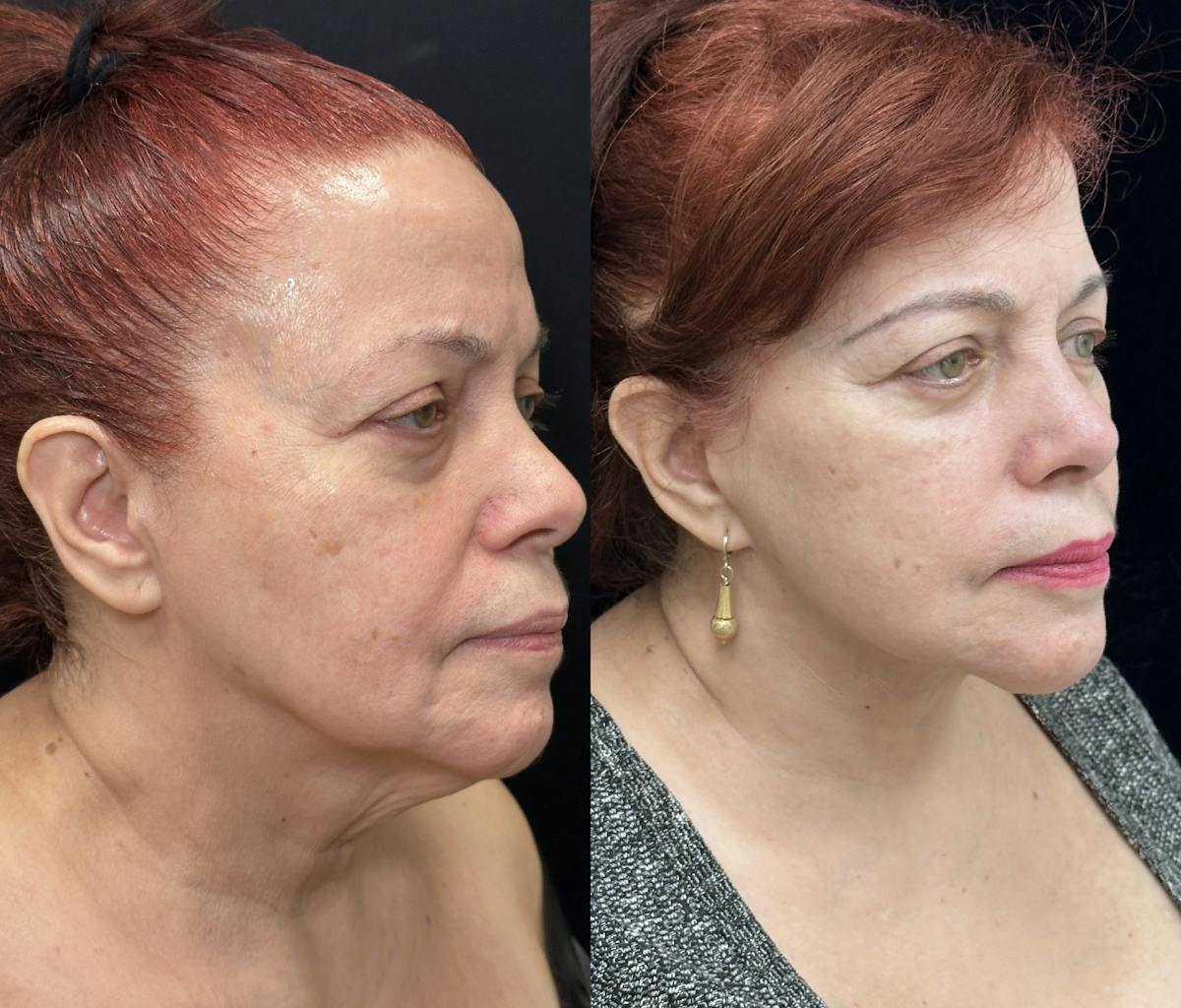 Necklift Before & After Gallery - Patient 407641 - Image 3