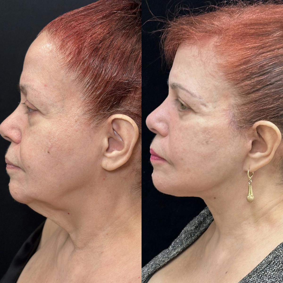 Necklift Before & After Gallery - Patient 407641 - Image 2