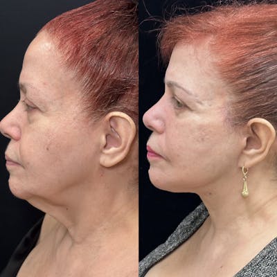 Deep Plane Facelift Before & After Gallery - Patient 109873 - Image 2