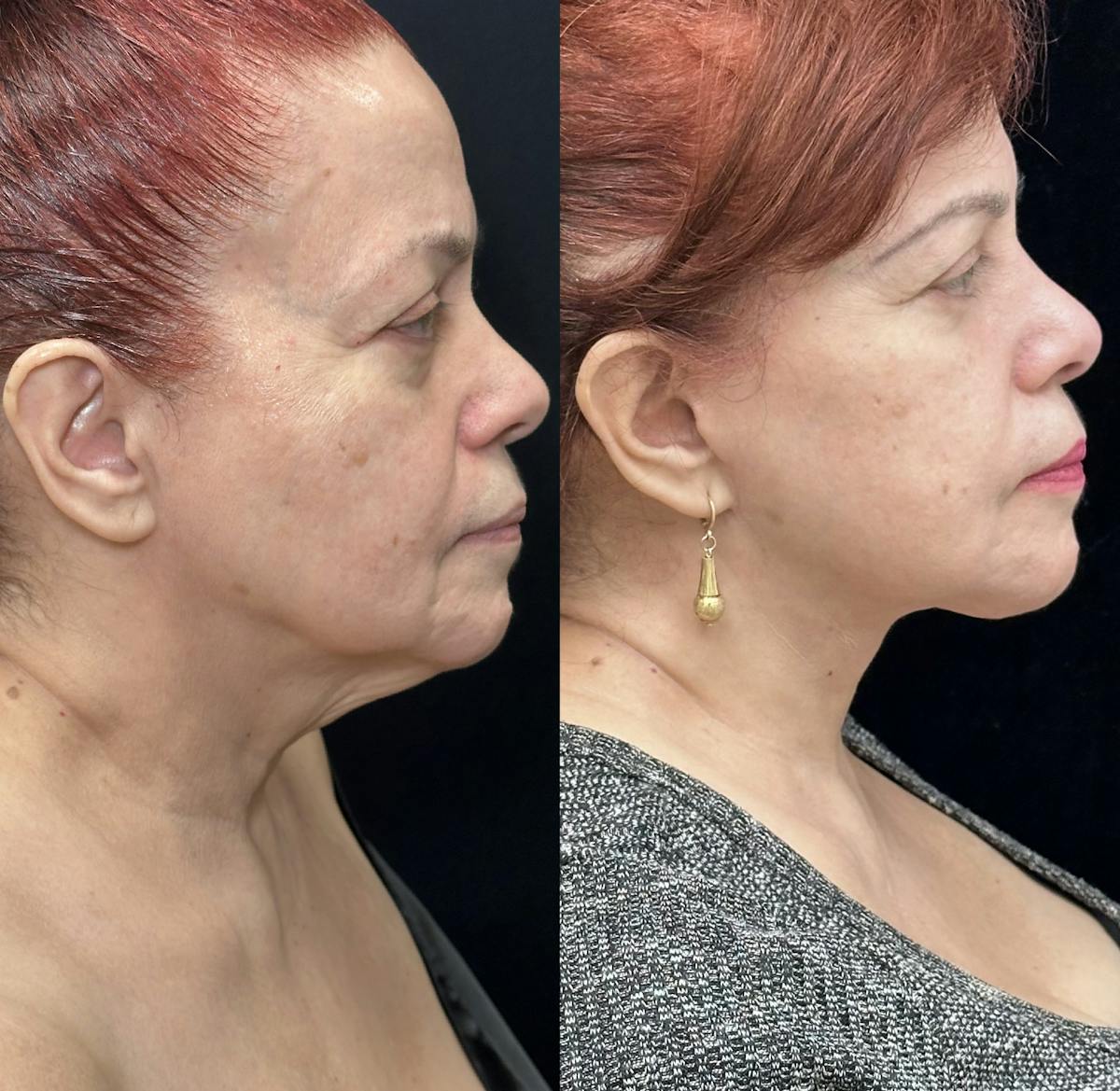 Necklift Before & After Gallery - Patient 407641 - Image 4