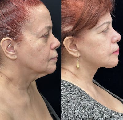 Deep Plane Facelift Before & After Gallery - Patient 109873 - Image 4