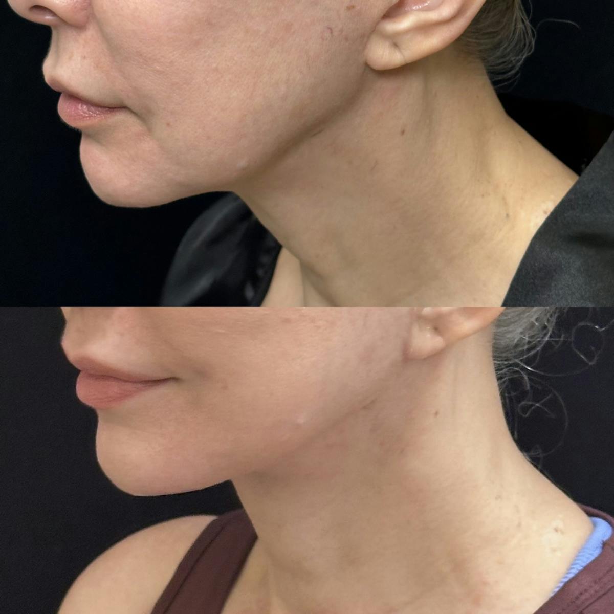 Necklift Before & After Gallery - Patient 229241 - Image 1