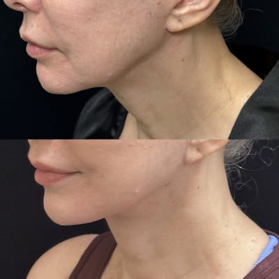 Deep Plane Facelift Before & After Gallery - Patient 235436 - Image 1