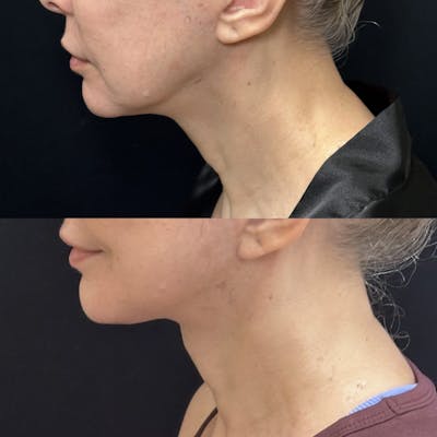 Deep Plane Facelift Before & After Gallery - Patient 235436 - Image 4