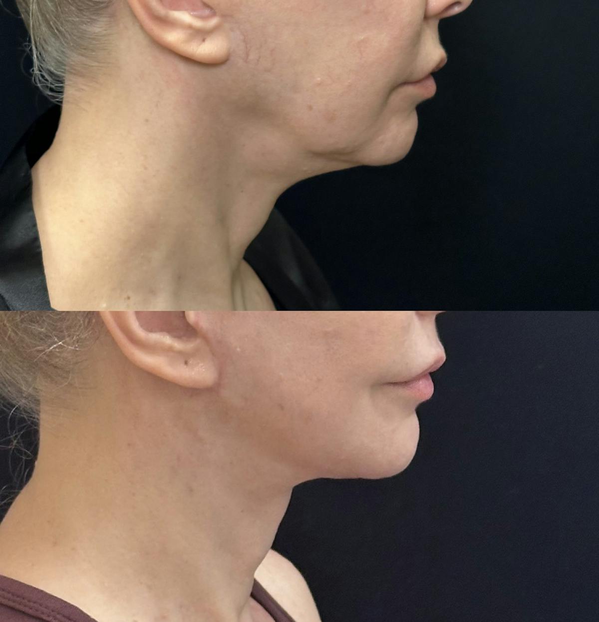 Necklift Before & After Gallery - Patient 229241 - Image 3