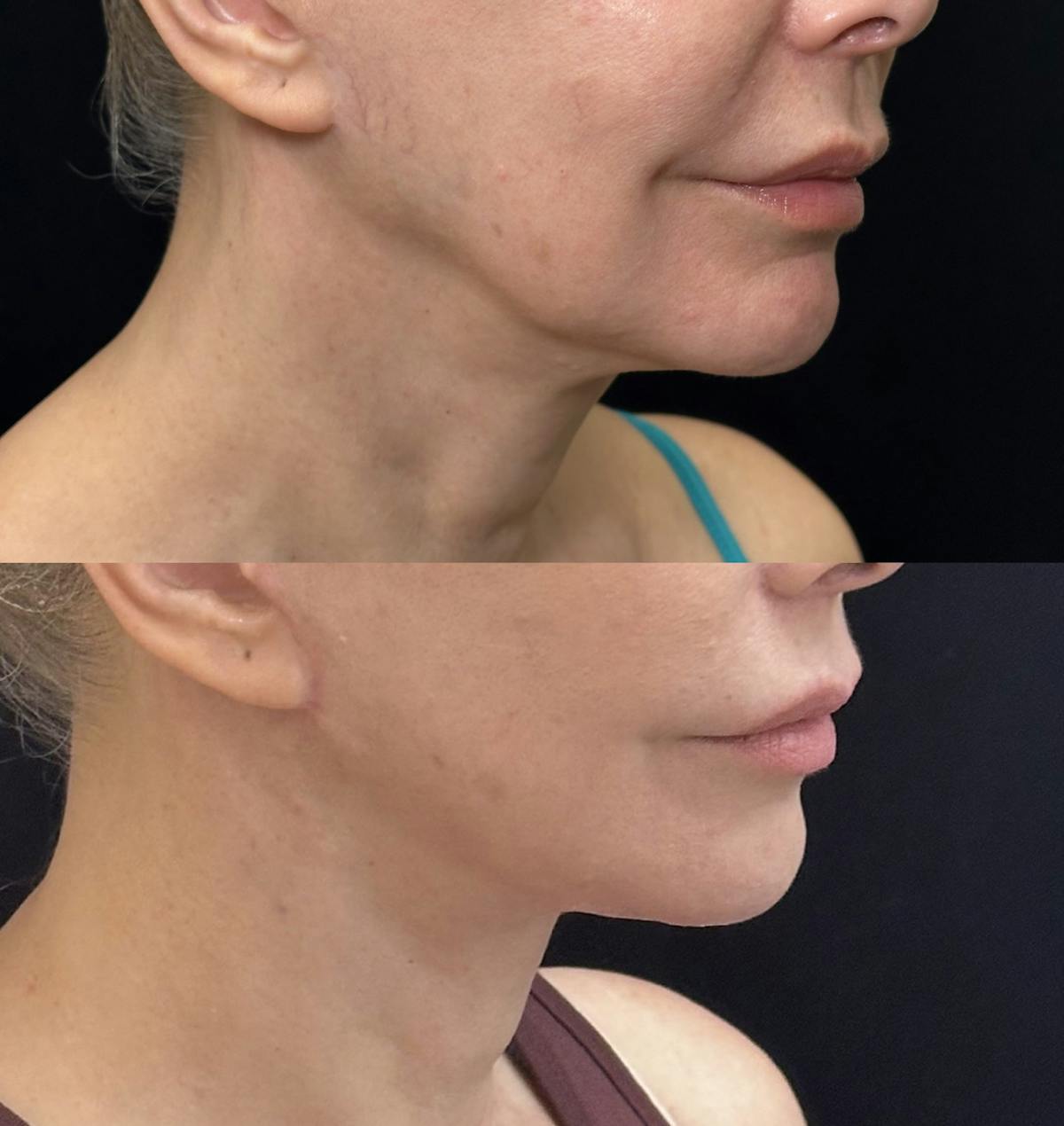 Necklift Before & After Gallery - Patient 229241 - Image 2