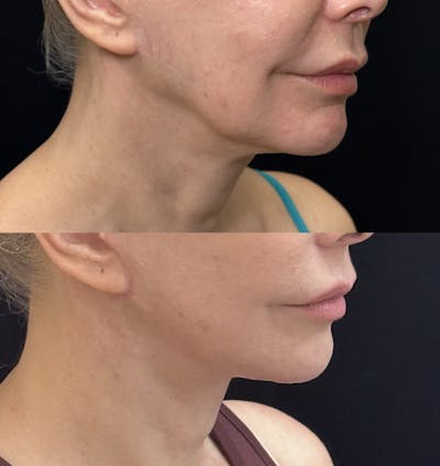 Deep Plane Facelift Before & After Gallery - Patient 235436 - Image 2