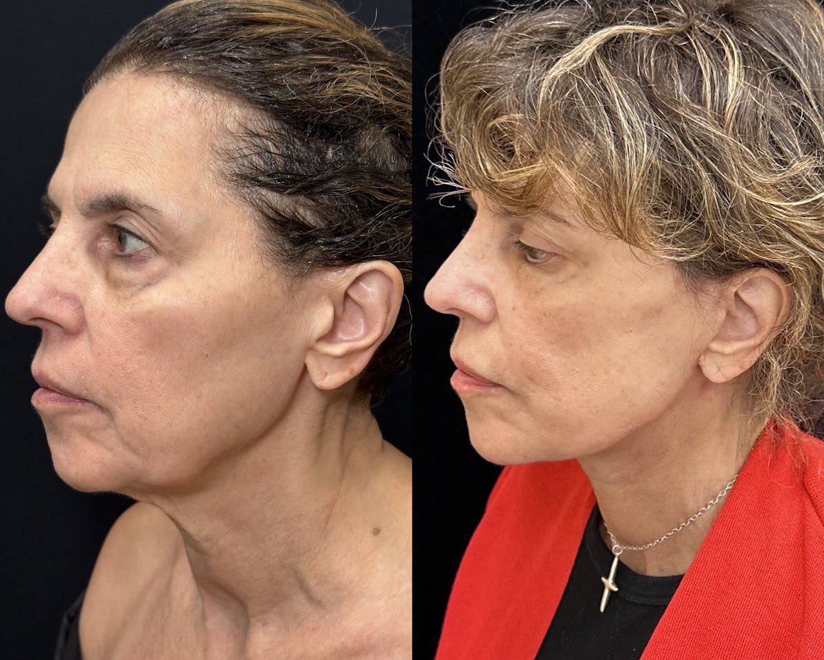  Upper Blepharoplasty Before & After Gallery - Patient 118426 - Image 2