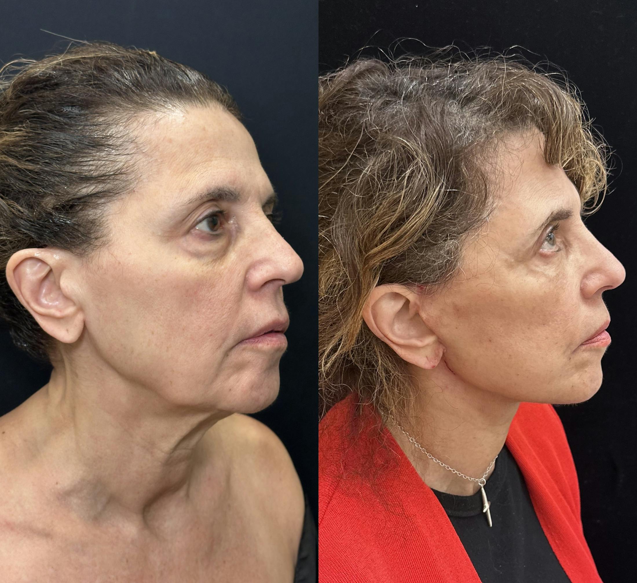 Lower Blepharoplasty Before & After Gallery - Patient 327929 - Image 3