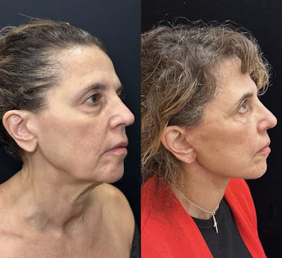 Deep Plane Facelift Before & After Gallery - Patient 450531 - Image 3