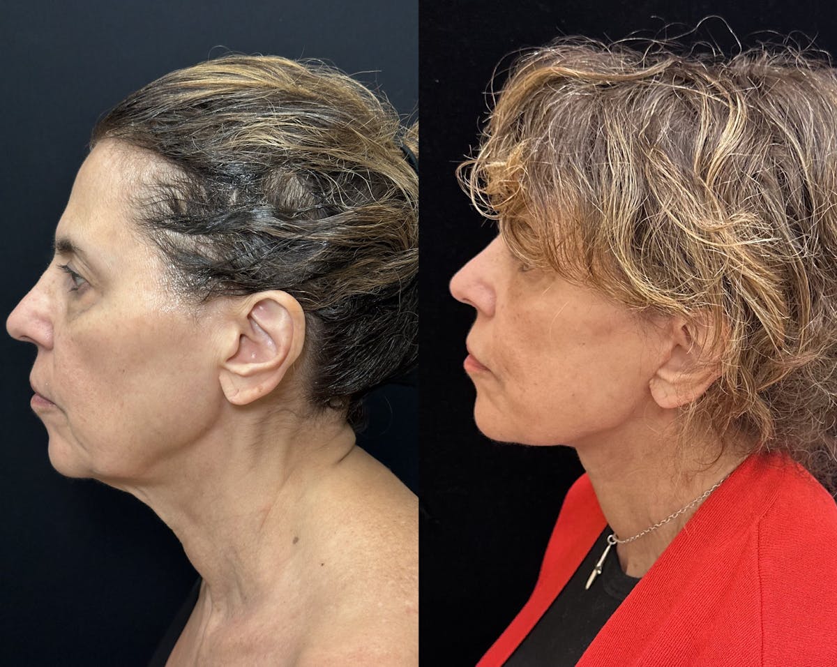  Upper Blepharoplasty Before & After Gallery - Patient 118426 - Image 4