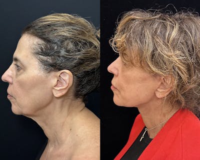 Deep Plane Facelift Before & After Gallery - Patient 450531 - Image 4