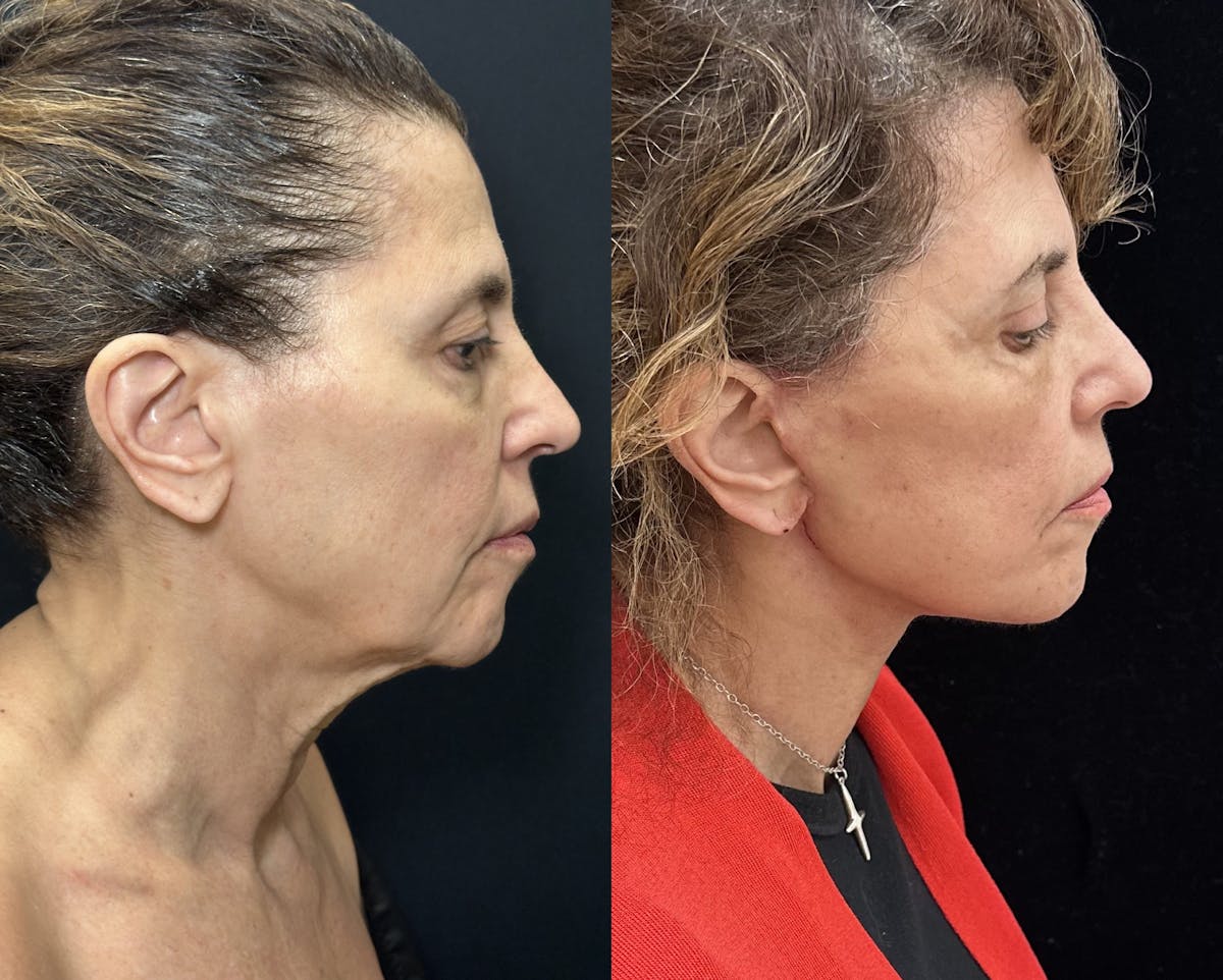  Upper Blepharoplasty Before & After Gallery - Patient 118426 - Image 5