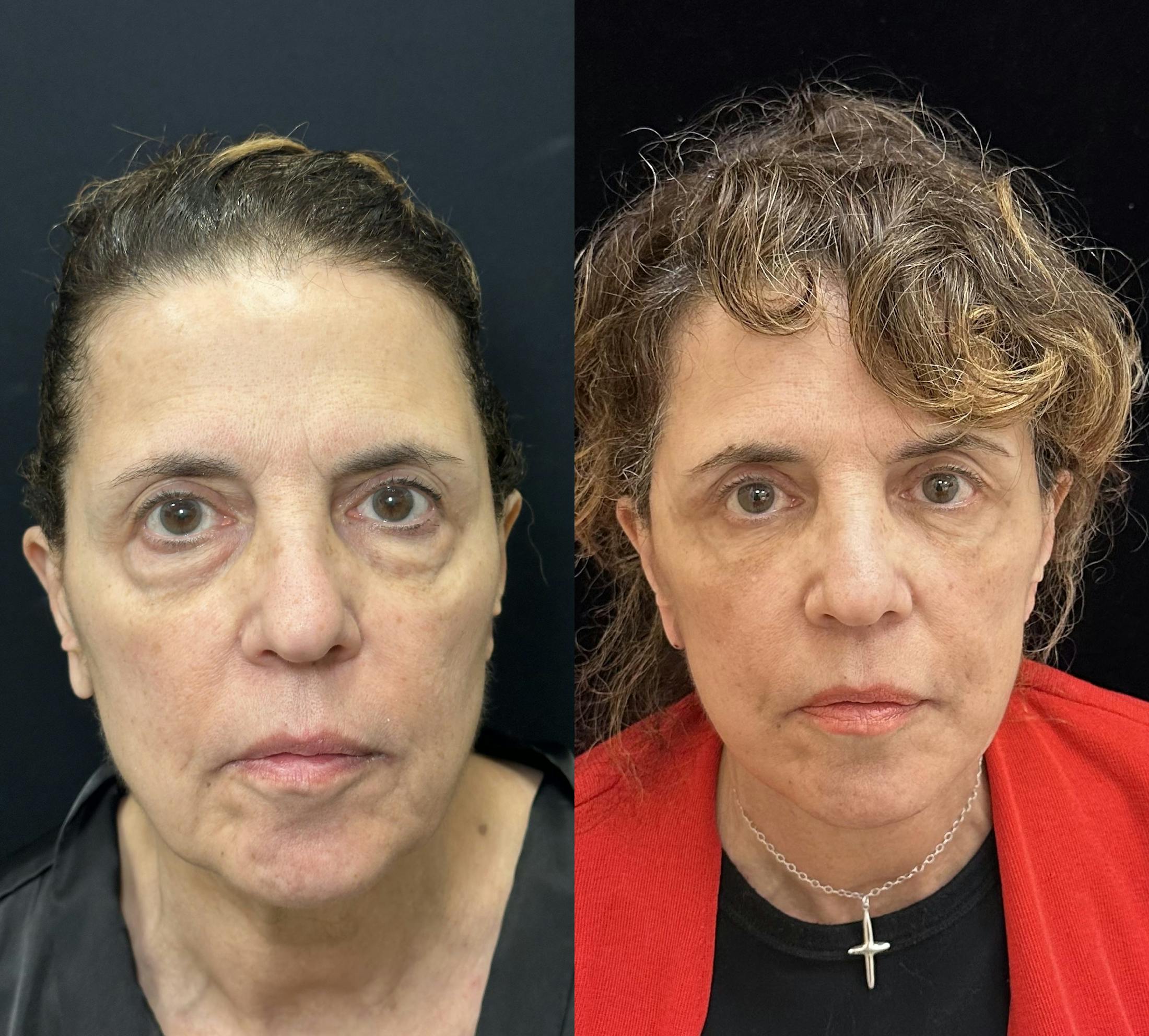 Lower Blepharoplasty Before & After Gallery - Patient 327929 - Image 1