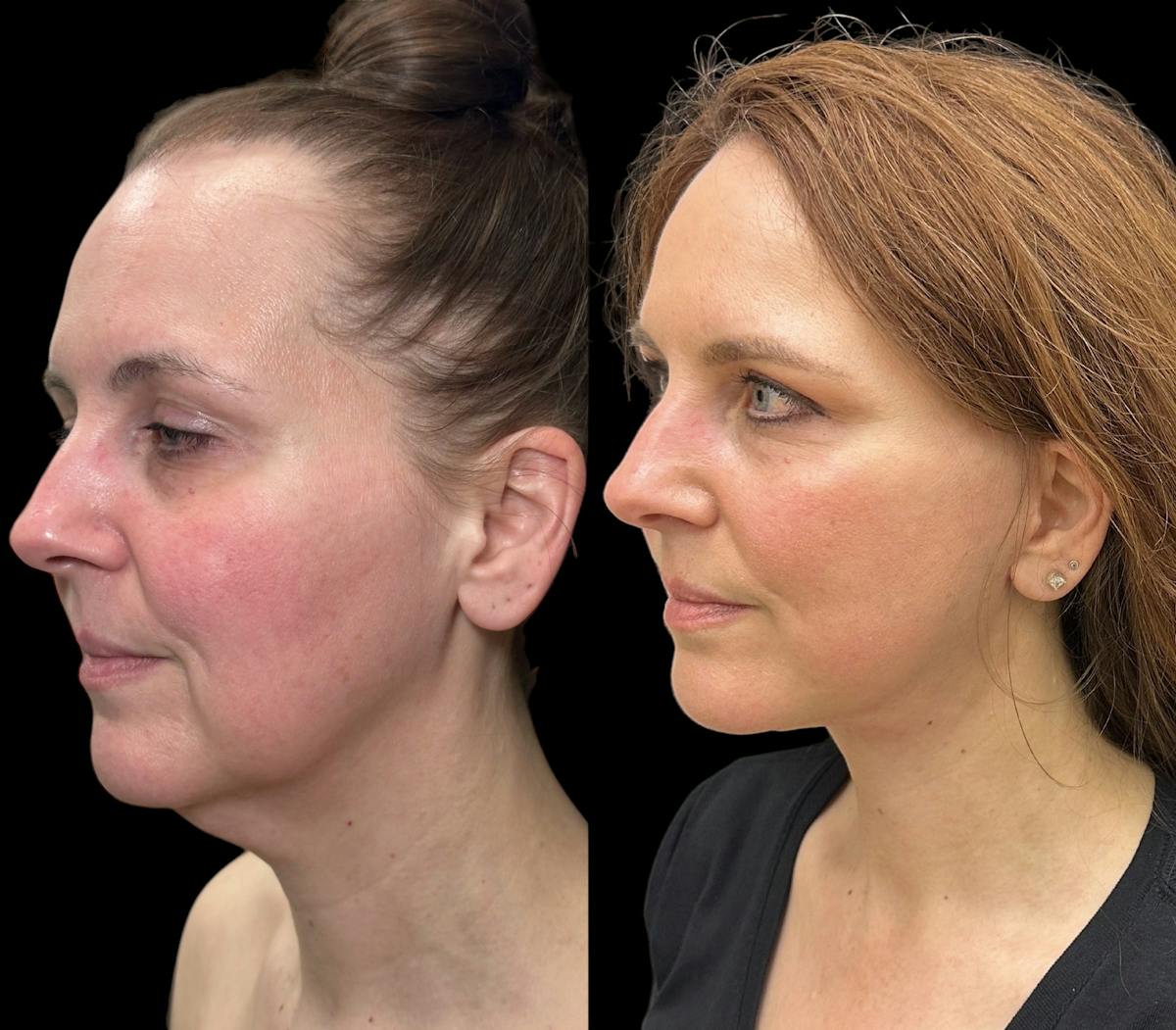 Necklift Before & After Gallery - Patient 392152 - Image 1