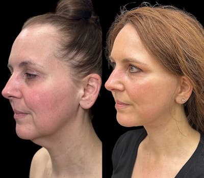 Deep Plane Facelift Before & After Gallery - Patient 720660 - Image 4