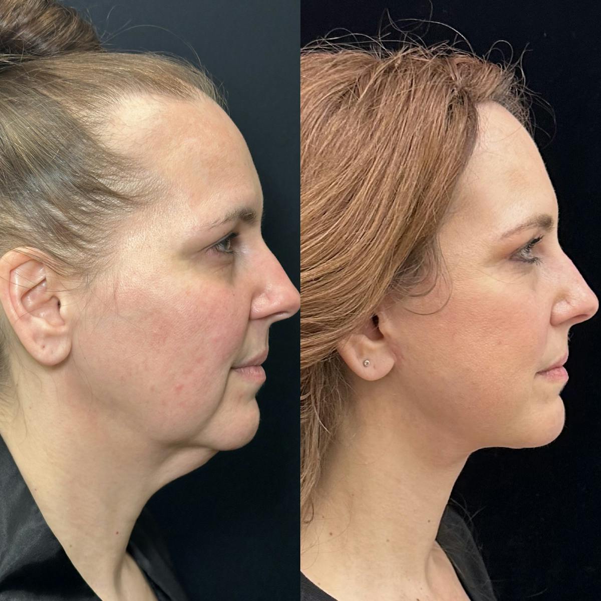 Necklift Before & After Gallery - Patient 392152 - Image 2