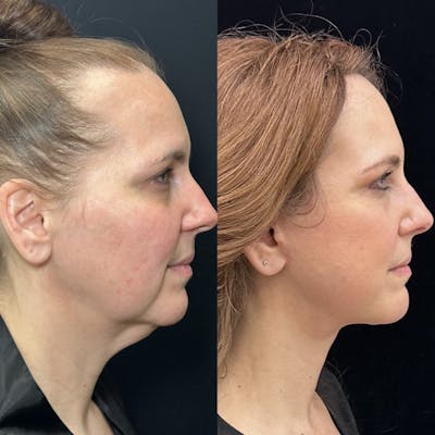 Deep Plane Facelift Before & After Gallery - Patient 720660 - Image 1