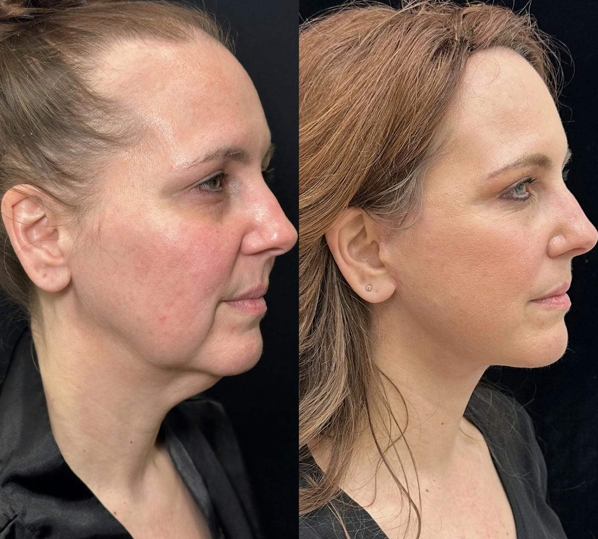 Necklift Before & After Gallery - Patient 392152 - Image 3