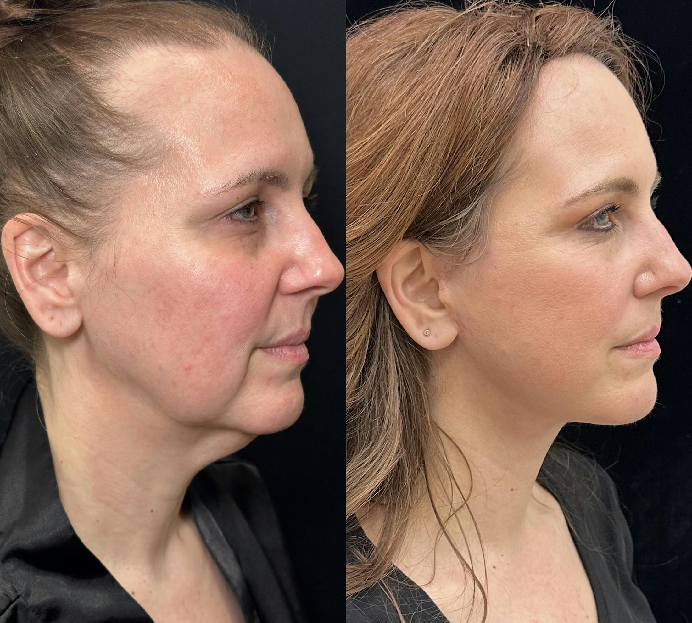 Deep Plane Facelift Before & After Gallery - Patient 720660 - Image 2