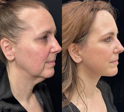 Deep Plane Facelift Before & After Gallery - Patient 720660 - Image 2