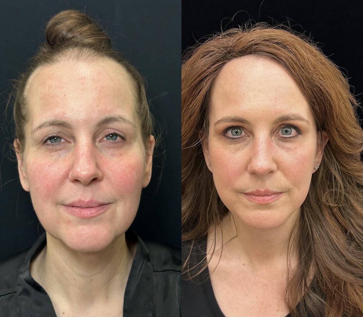 Necklift Before & After Gallery - Patient 392152 - Image 4