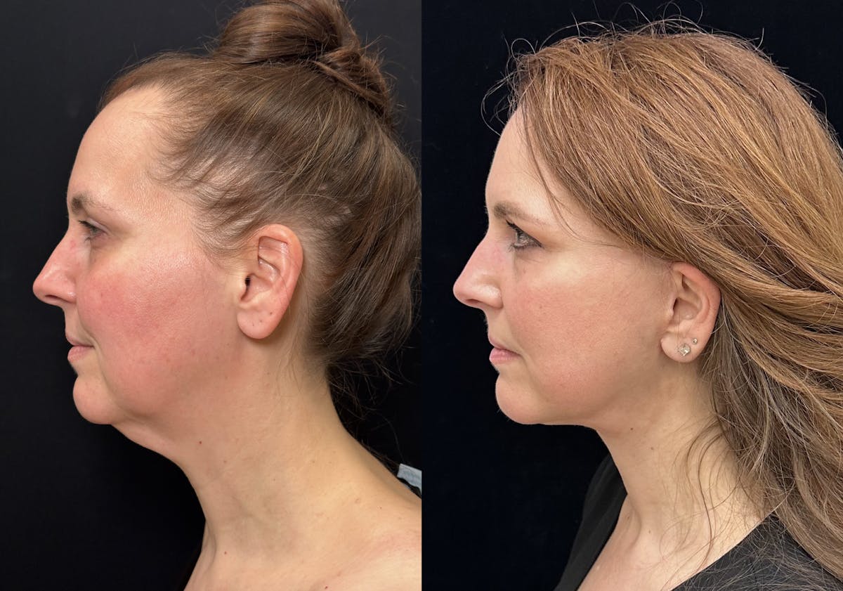 Necklift Before & After Gallery - Patient 392152 - Image 5