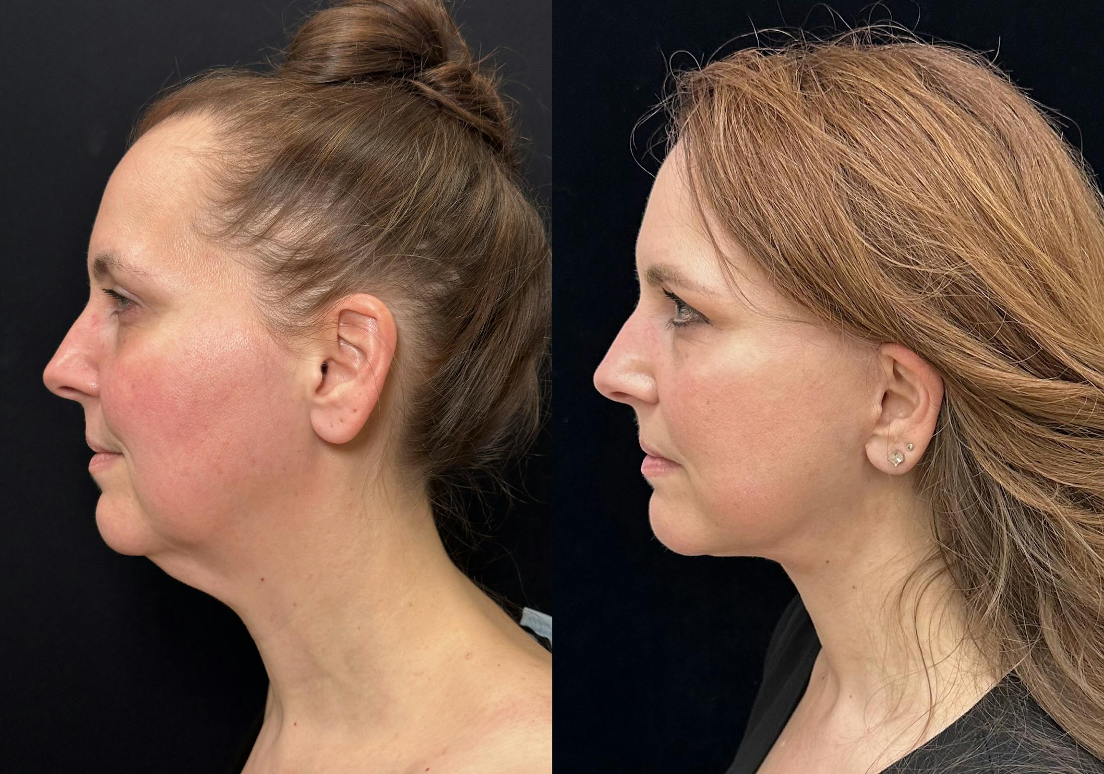 Deep Plane Facelift Before & After Gallery - Patient 720660 - Image 5