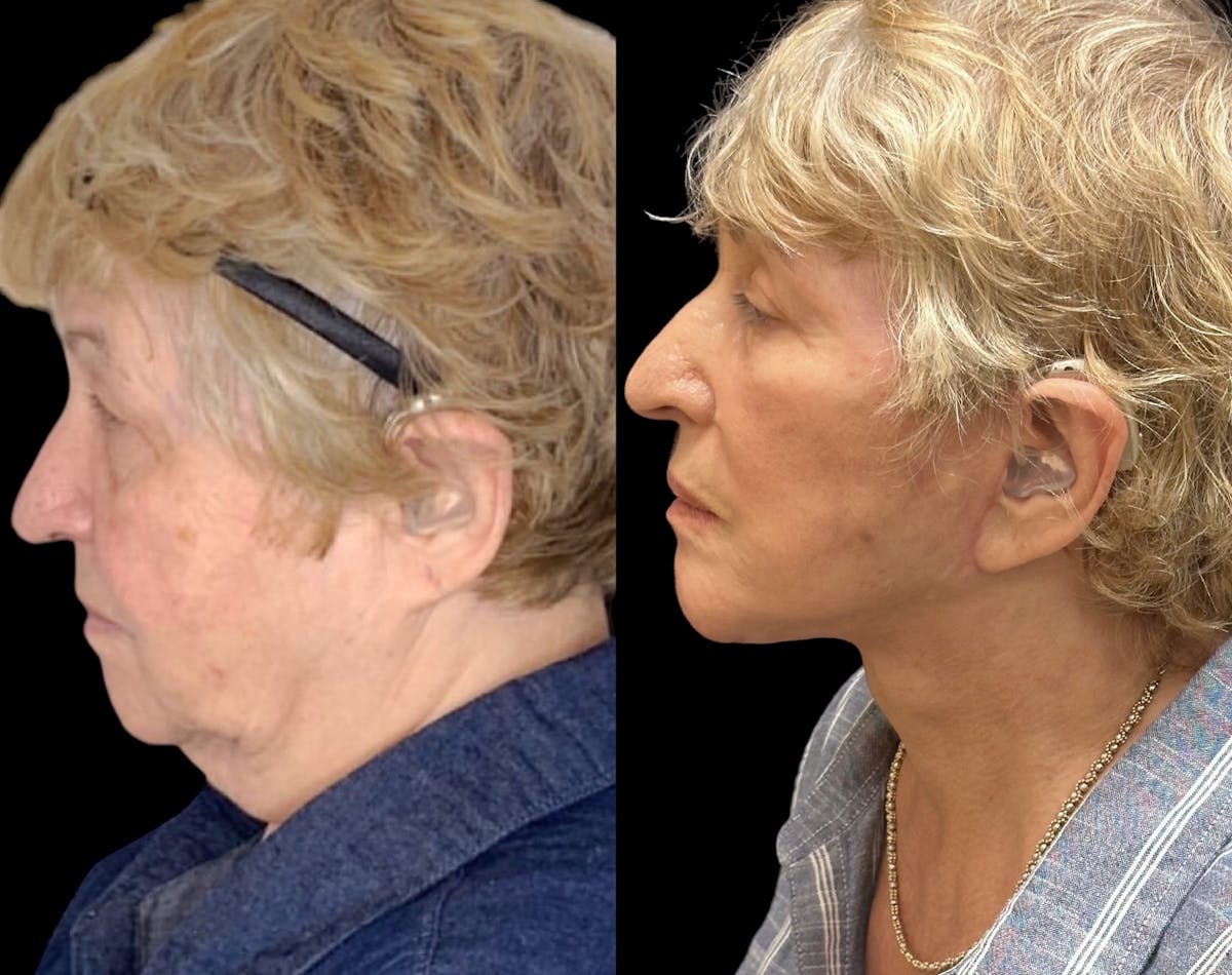 Necklift Before & After Gallery - Patient 184310 - Image 4