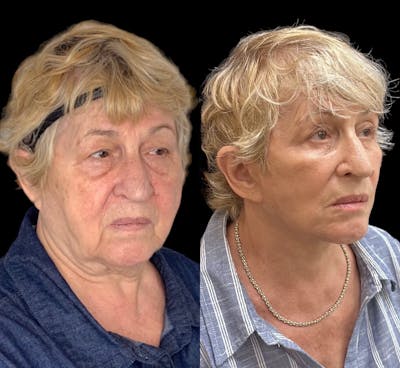 Deep Plane Facelift Before & After Gallery - Patient 803093 - Image 2