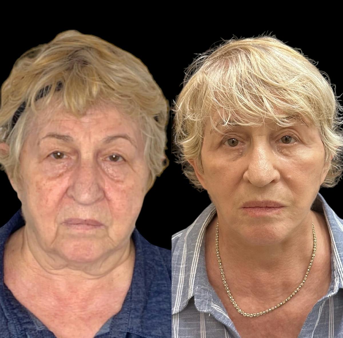 Necklift Before & After Gallery - Patient 184310 - Image 1