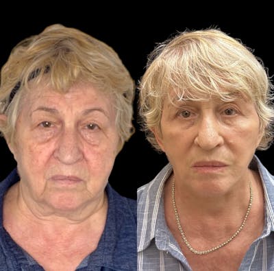 Deep Plane Facelift Before & After Gallery - Patient 803093 - Image 1