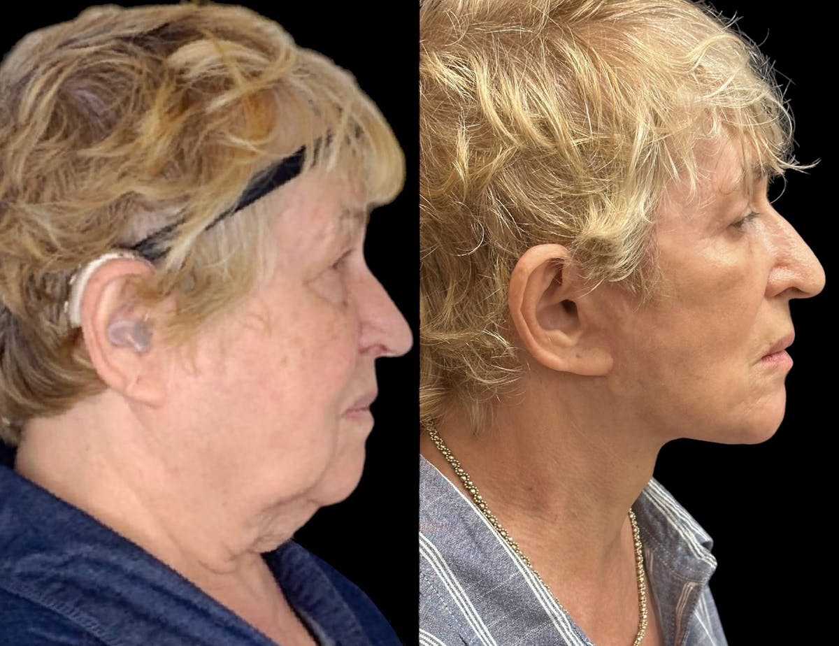 Necklift Before & After Gallery - Patient 184310 - Image 3