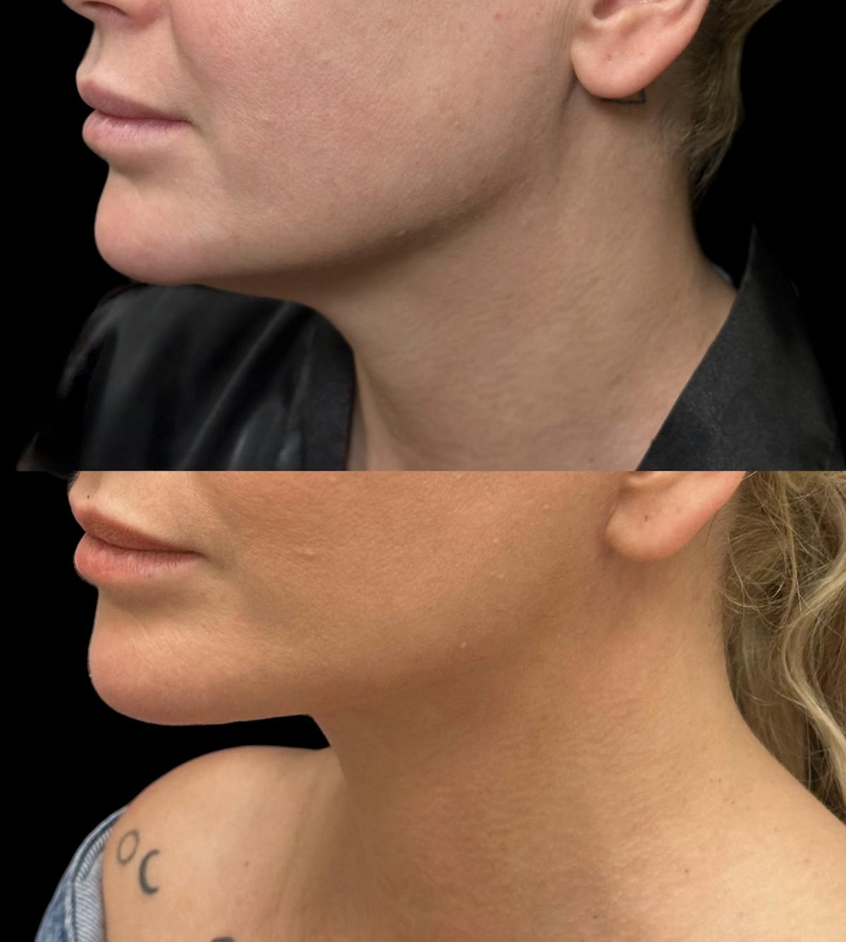 Lower Blepharoplasty Before & After Gallery - Patient 184138 - Image 1