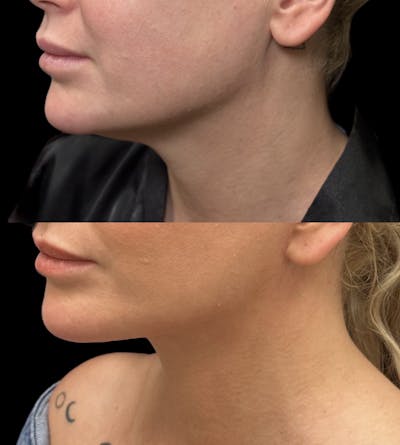 Deep Plane Facelift Before & After Gallery - Patient 126905 - Image 1