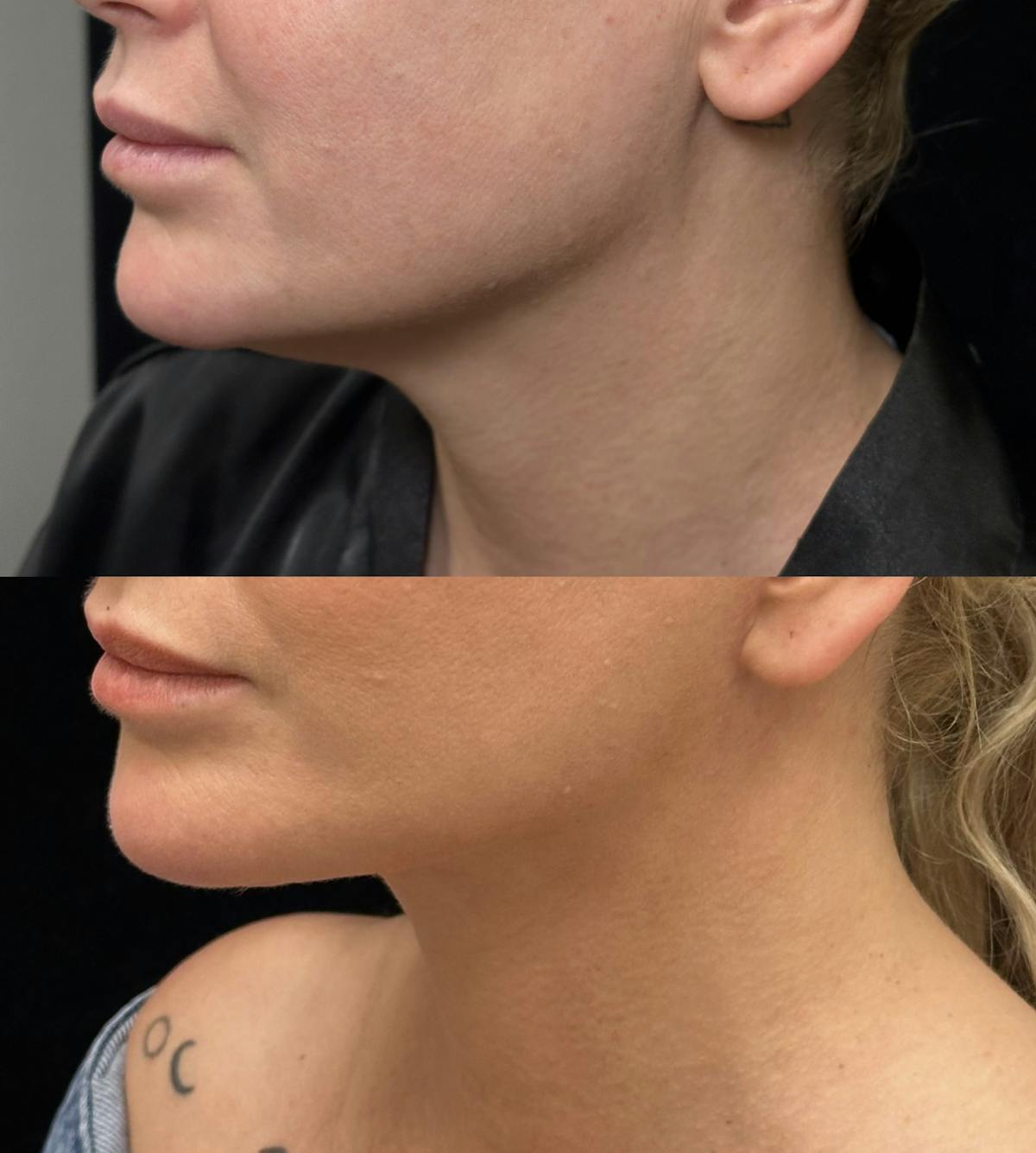 Lower Blepharoplasty Before & After Gallery - Patient 184138 - Image 5