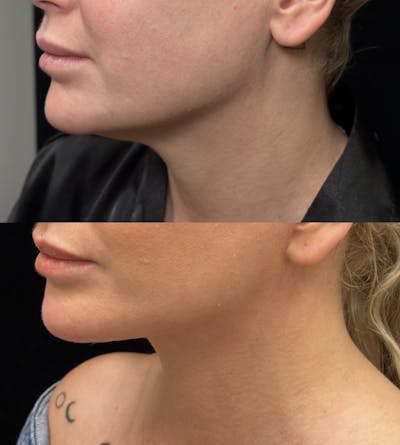 Deep Plane Facelift Before & After Gallery - Patient 126905 - Image 5