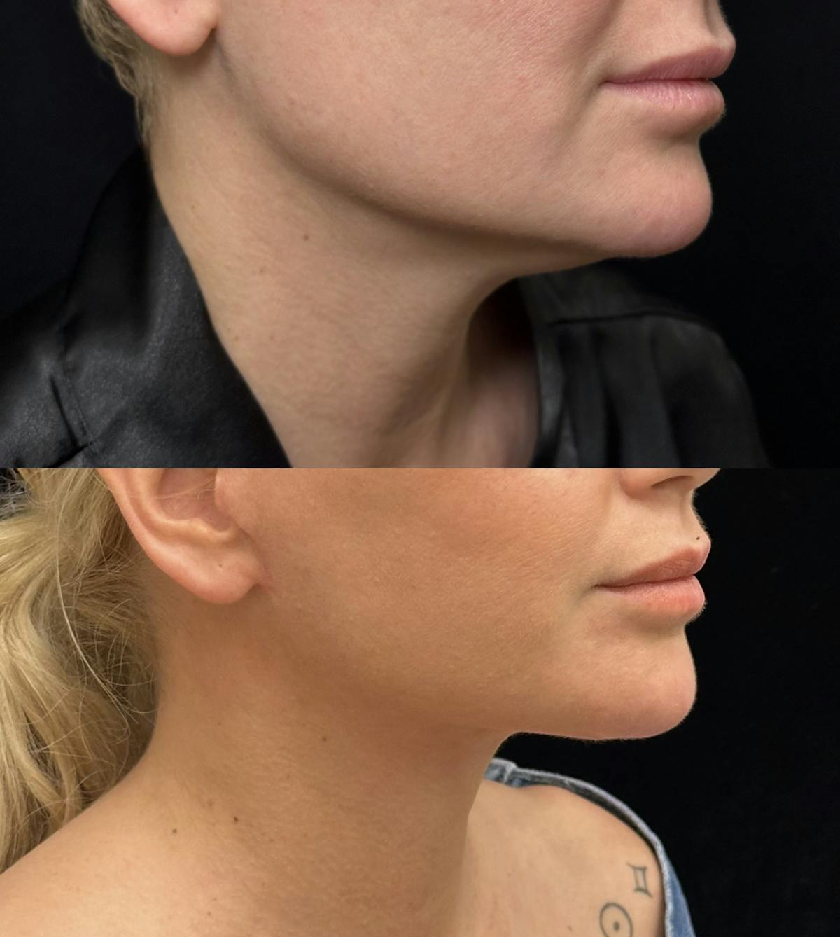 Lower Blepharoplasty Before & After Gallery - Patient 184138 - Image 2