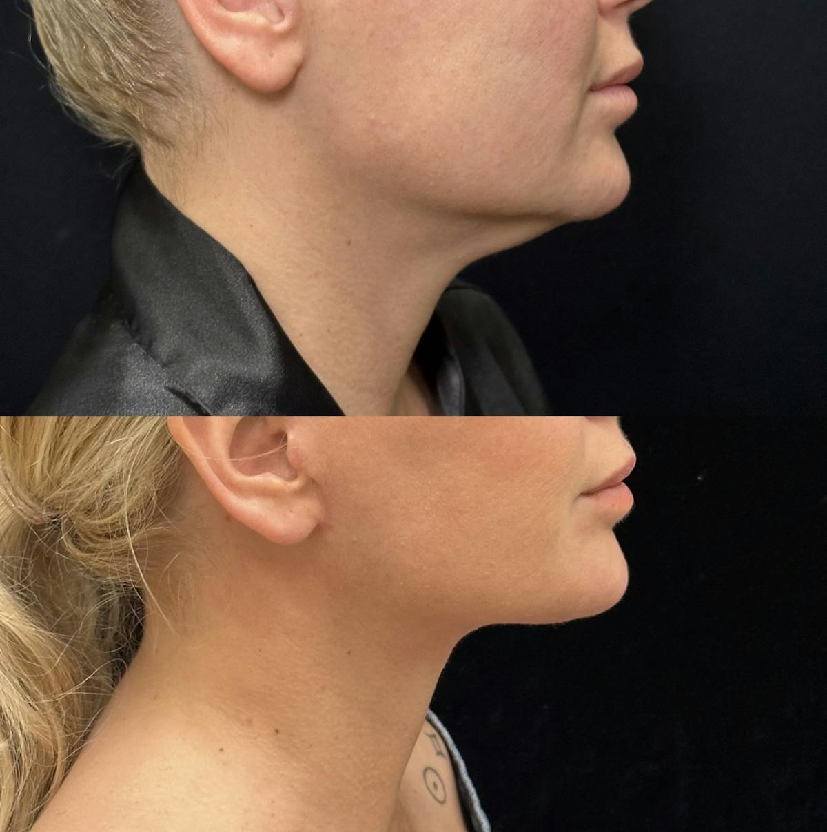 Lower Blepharoplasty Before & After Gallery - Patient 184138 - Image 3