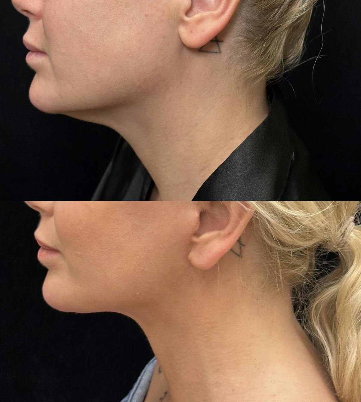 Lower Blepharoplasty Before & After Gallery - Patient 184138 - Image 4