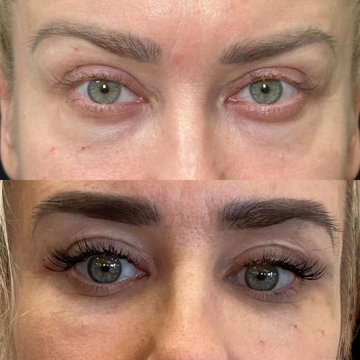 Lower Blepharoplasty Before & After Gallery - Patient 184138 - Image 6