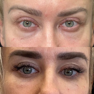 Deep Plane Facelift Before & After Gallery - Patient 126905 - Image 6